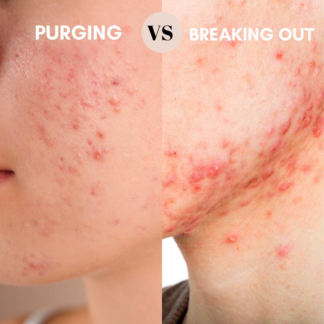 Breakouts Vs Purging - Skin purging starter guide